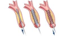 Tư vấn: Sau đặt stent mạch vành có phải tiếp tục uống thuốc không?